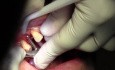 Wszczepienie implantu - #5