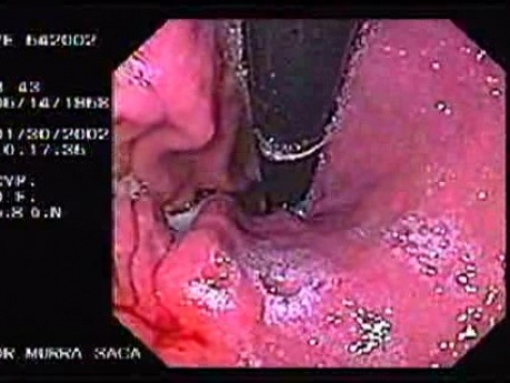 Wczesny rak żołądka z komórkami sygnetowatymi - endoskopia (3 z 3)
