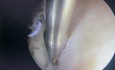 Polip endometrialny 