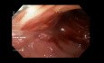 Krwawienie u pacjenta z "Mega Stentem" po resekcji rękawowej żołądka 