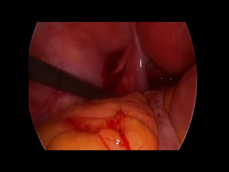 Przypadkowo zdiagnozowana ciąża ektopowa - ultrasonografia laparoskopowa