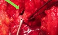 Uretroplastyka tylna po radioterapii z powodu raka stercza