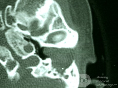 Automastoidektomia w wyniku rogowacenia obturacyjnego (TK)