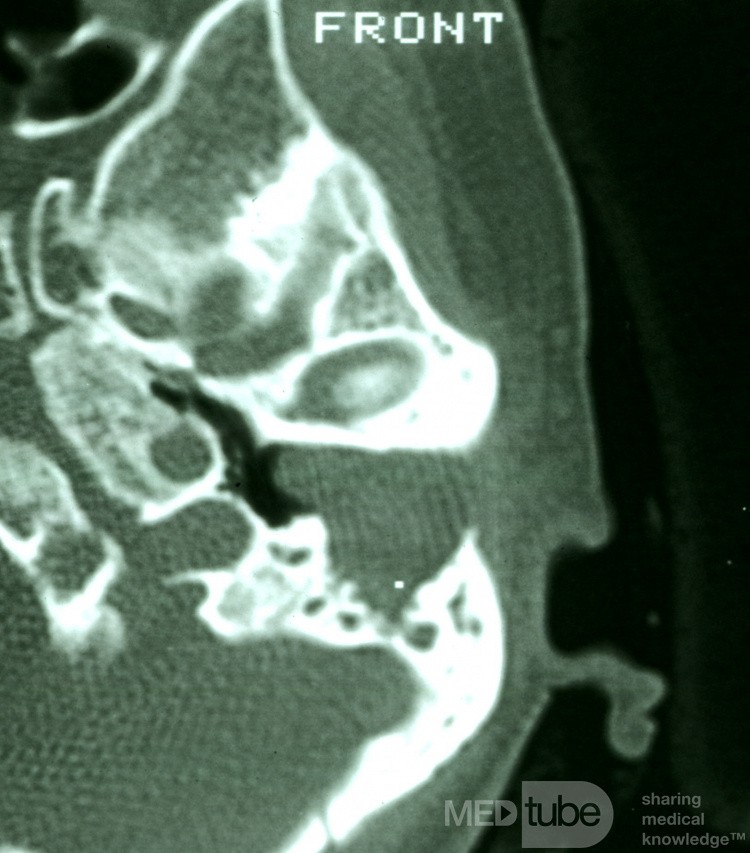 Automastoidektomia w wyniku rogowacenia obturacyjnego (TK)