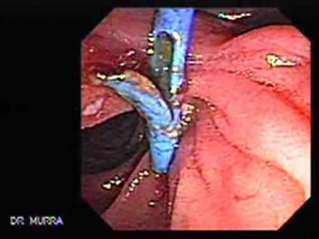 Gruczolakorak brodawki Vatera - migracja stentu (5 z 7)
