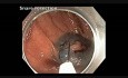 Kolonoskopia: jak wykonać endoskopową resekcję śluzówkową 1