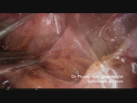 Endometrioza naciekająca pęcherz moczowy,więzadło krzyżowo-maciczne oraz przestrzeń odbytniczo-maciczną (zatokę Douglasa). 