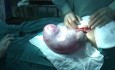 Przypadek łagodnych guzów jajnika w przebiegu ciąży
