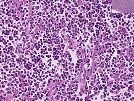Plazmocytoma pozaszpikowa - Badanie histopatologiczne nosa