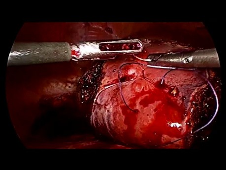 Resekcja segmentów II, III, VI i VII wątroby metodą laparoskopową