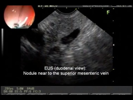 Insulinoma - endoultrasonografia (EUS)