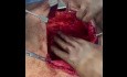 Hernioplastyka z płatem otrzewnowym