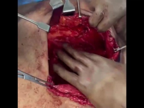 Hernioplastyka z płatem otrzewnowym