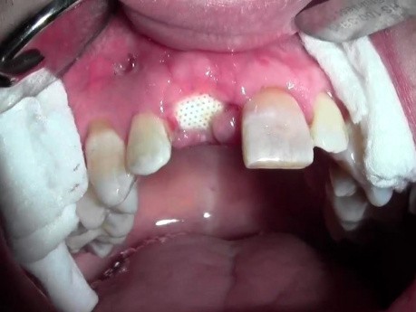 Ekstrakcja zęba 1-8 z przeszczepem kieszeni kostnej - 2 tyg. po