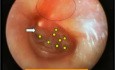 Ostre zapalenie ucha środkowego - obraz endoskopowy we wczesnej fazie