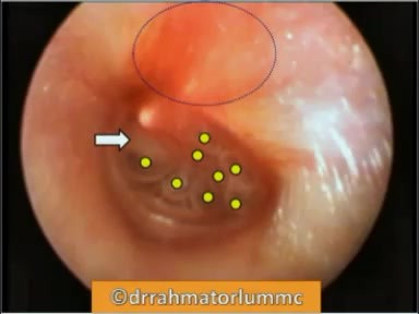 Ostre zapalenie ucha środkowego - obraz endoskopowy we wczesnej fazie