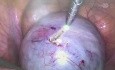 Laser w leczeniu endometriozy