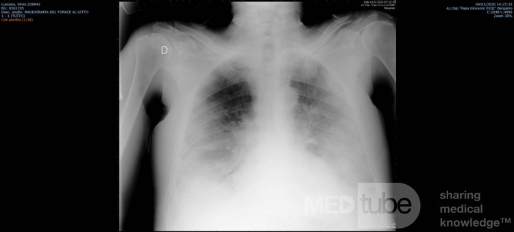 RTG klatki piersiowej - COVID-19 (1)
