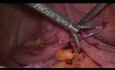 Paliatywna laparoskopowa ileo-transwersostomia