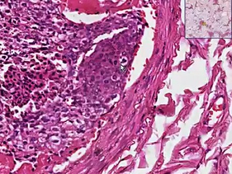 Zator spowodowany przez komórki nowotworowe - histopatologia płuc