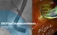 ERCP bei Choledocholithiasis