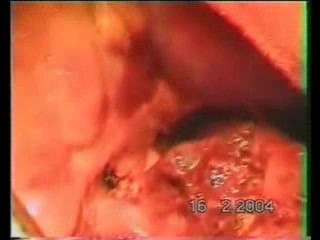 Lobektomia z powodu jamy gruźliczej