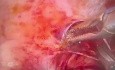 Resekcja guzka endometrialnego na więzadle krzyżowo-macicznym