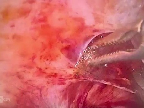 Resekcja guzka endometrialnego na więzadle krzyżowo-macicznym