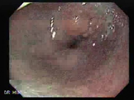 Rak Płaskonabłonkowy Dystalnej Części Przełyku - Widok Endoskopowy