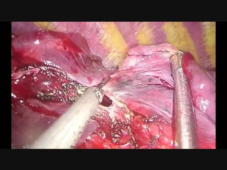 Wideotorakoskopowe usunięcie płata środkowego płuca prawego oraz segmentektomia S3 z pojedynczego, podmostkowego cięcia