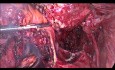 Częściowa resekcja esicy i odbytnicy z powodu endometriozy