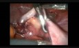 Laparoskopowa apendektomia u pacjentki z rozpoznaną endometriozą.