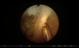 Enukleacja prostaty za pomocą lasera GreenLight