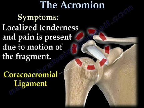 Os Acromiale - brak zrostu jąder kostnienia wyrostka barkowego łopatki