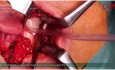 Osteosynteza podstawy wyrostka kłykciowego żuchwy z zastosowaniem płytki 3AXP.