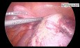 Laparoskopowa ooforektomia z powodu skrętu jajnika