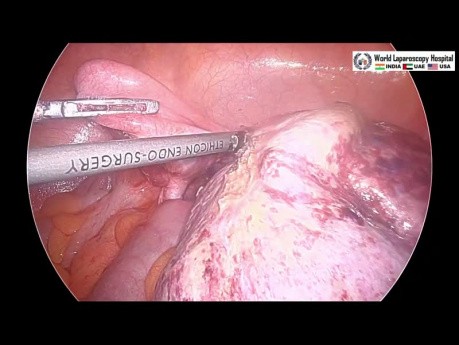 Laparoskopowa ooforektomia z powodu skrętu jajnika