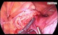 Całkowita laparoskopowa histerektomia- znacznie powiększona macica z masywnym mięśniakiem