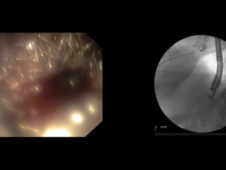 Trzustkowa gastrostomia