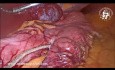 Olbrzymi naczyniak wątroby jako przypadkowy guz podczas rękawowej resekcji żołądka