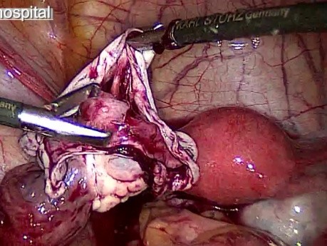 Leczenie torbieli skórzastej - wycięcie z pomocą techniki laparoskopowej