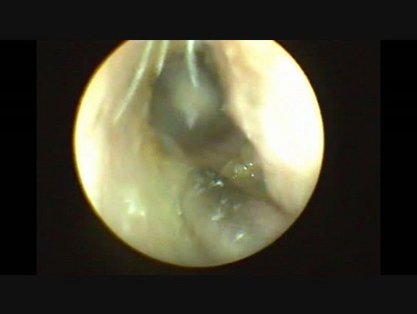 Endoskopowa paracenteza i drenaż wentylacyjny ucha środkowego