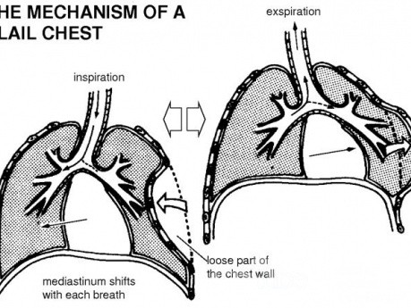 Mechanizm powstawania wiotkiej klatki piersiowej