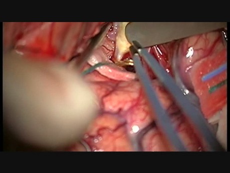Mikrochirurgiczne wyłączenie tętniaka olbrzymiego tetnicy środkowej mózgu prawej