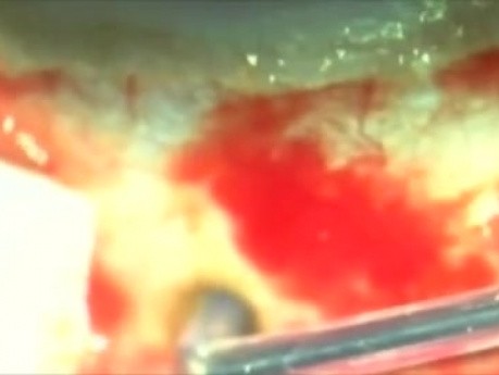 Operacja jaskry za pomocą Plasma Blade - filtrowanie cieczy wodnistej z komory tylnej