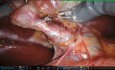 Robotic Cholecystectomy Supra-Pubic Bikini-Line Cholangio-ICG and IOC