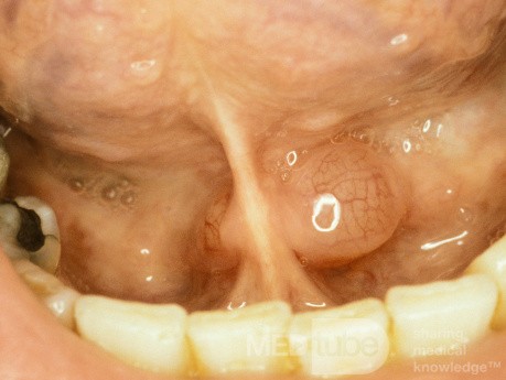 Śluzowa torbiel na dnie jamy ustnej