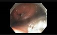 Poprzecznica - endoskopowa mukozektomia polipa