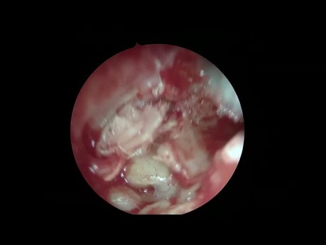 Endoskopowe podejście łączone do perlaka: dostęp przez przewód słuchowy zewnętrzny + wyrostek sutkowy