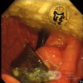 Erozja opaski żołądka - obraz endoskopowy